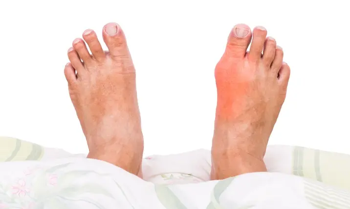 gout foot problems